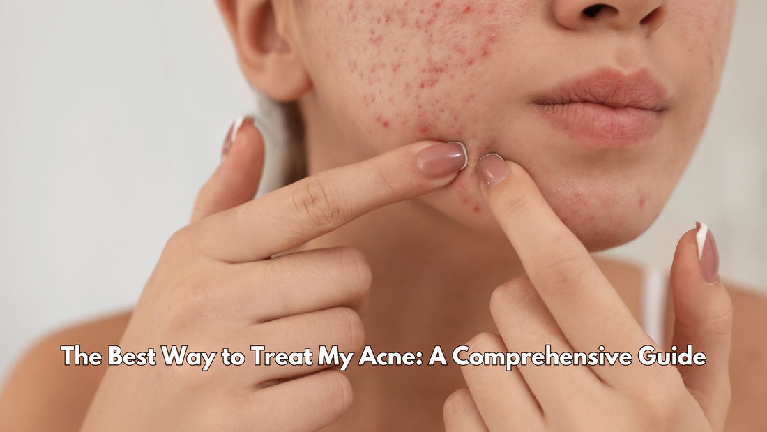 The Best Way to Treat My Acne: A Comprehensive Guide
